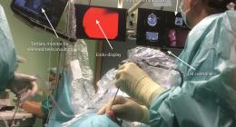 NESS – navigation endoscopic sinus surgery with virtual endoscopy (VE) as well as  virtual surgery (VS); there is a distinction between the interpretation of gestures in 3DVR and VE because of a different manner of movements while navigating throughout the virtual space